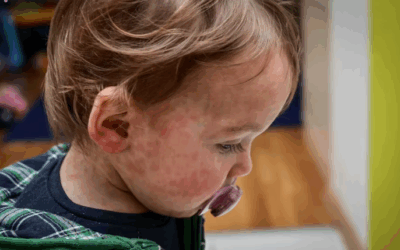 Measles cases are surging globally. Should children be vaccinated earlier?