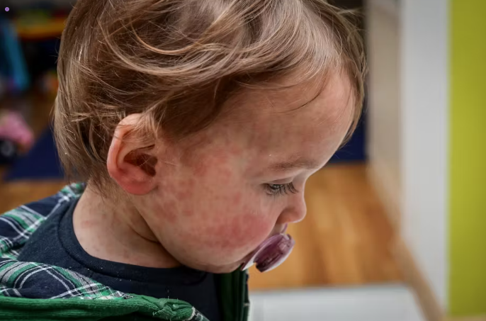 Measles cases are surging globally. Should children be vaccinated earlier?